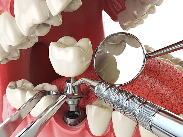 Best Emergency Wisdom Teeth Removal in Agua Dulce, CA